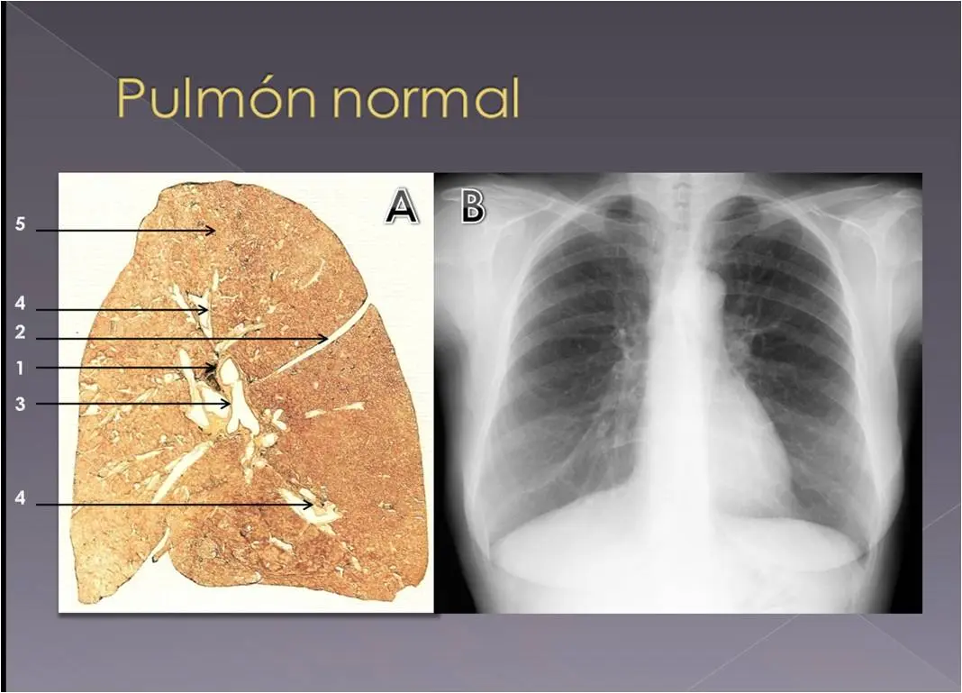 densidad parenquimatosa pulmonar en loros - Qué es parenquima pulmonar normal