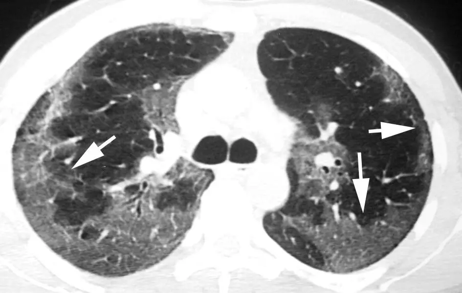 densidad parenquimatosa pulmonar en loros - Qué es una lesión parenquimatosa pulmonar
